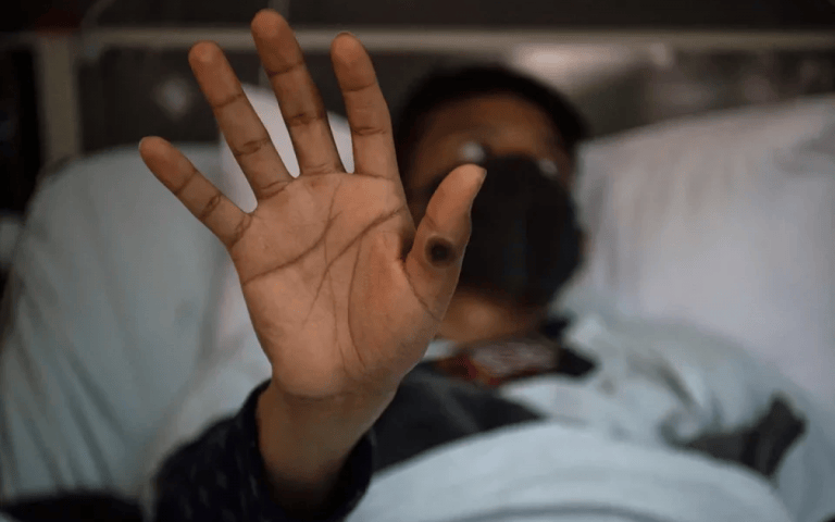 Estado do Rio de Janeiro soma 15 casos de mpox este ano